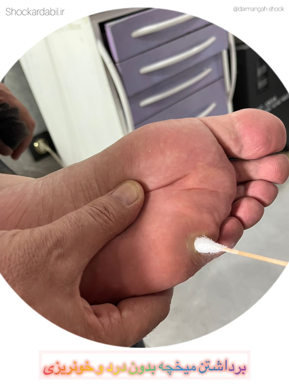 برداشتن میخچه