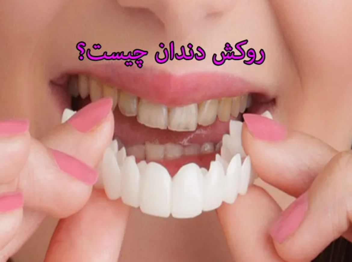 روکش دندان چیست؟