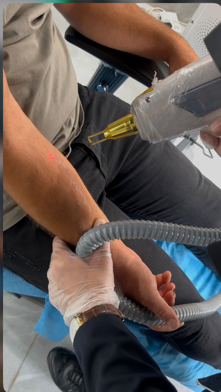 پاک کردن تتو