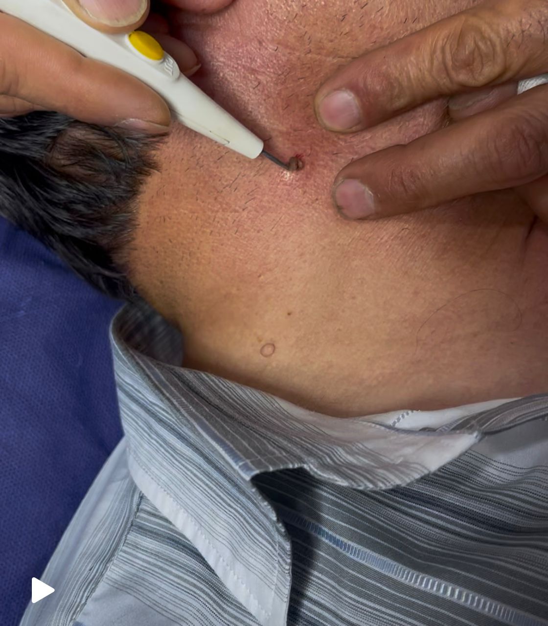 برداشتن خال 